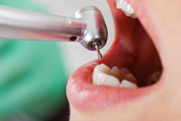 Best Emergency Root Canal Therapy in Irvine, CA